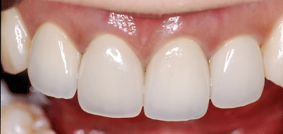 セラミックによる白い歯